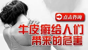 牛皮癣对于患者眼睛会造成哪些损害